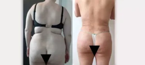 Dos et fesses d une femme avant/apres liposuccion | Dr Favre Lausanne