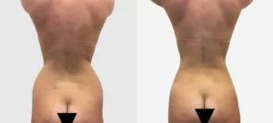 Dos et fesses d une femme avant/apres liposuccion | Dr Favre Lausanne