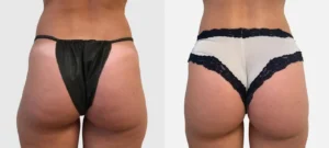Fesses d une femme avant/apres liposuccion cuisses externes et internes avec la technique Body-Jet | Dr Favre Lausanne