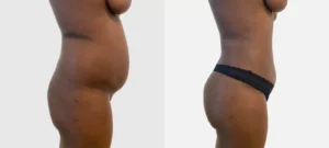 Ventre et fesses d une femme avant/apres liposuccion | Dr Favre Lausanne