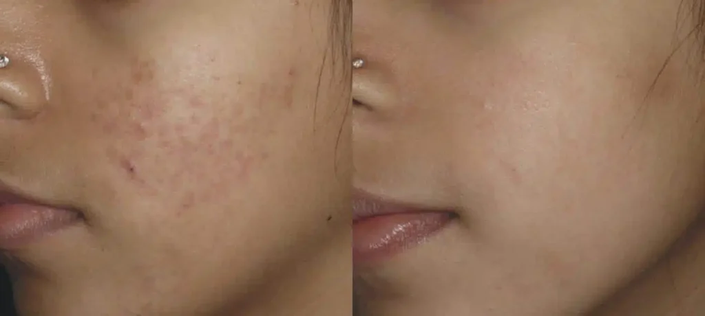 La joue d une jeunne femme avant/apres traitement Micro-Needling | Dr Favre Lausanne