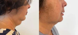 Photo comparative du menton d une femme avant/apres d une patiente qui a eu une liposuccion | Dr Favre Lausanne