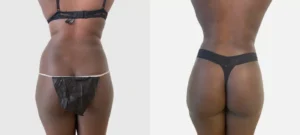 Fesses d une femme noire avant/apres liposuccion | Dr Favre Lausanne