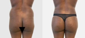 Fesses d une femme avant/apres liposuccion cuisses externes et internes | Dr Favre Lausanne