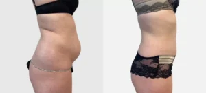 Photo de fesses d une femme avant/apres liposuccion | Dr Favre Lausanne