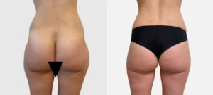 Photo de fesses d une femme avant/apres liposuccion | Dr Favre Lausanne