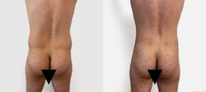 Photo de fesses d'un homme avant/après liposuccion | Dr Favre Lausanne