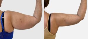 Bras d une femme avant/apres liposuccion | Dr Favre Lausanne