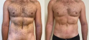 Ventre et torse d un homme avant/apres liposuccion | Dr Favre Lausanne