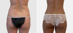 Fesses d'une femme avant/après liposuccion | Dr Favre Lausanne