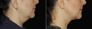 Visage de femme de profil droit montrant les joues avant/apres la procedure de Coolsculpting | Dr Favre Lausanne