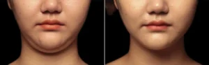 Visage de femme avant/apres une procedure de Coolsculpting | Dr Favre Lausanne | Dr Favre Lausanne
