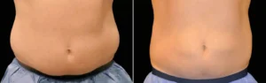 Apparence du ventre avant et apres la procedure de Coolsculpting | Dr Favre Lausanne