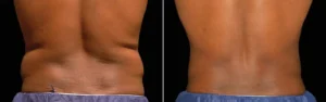 Apparence du dos avant et apres la procedure de Coolsculpting | Dr Favre Lausanne
