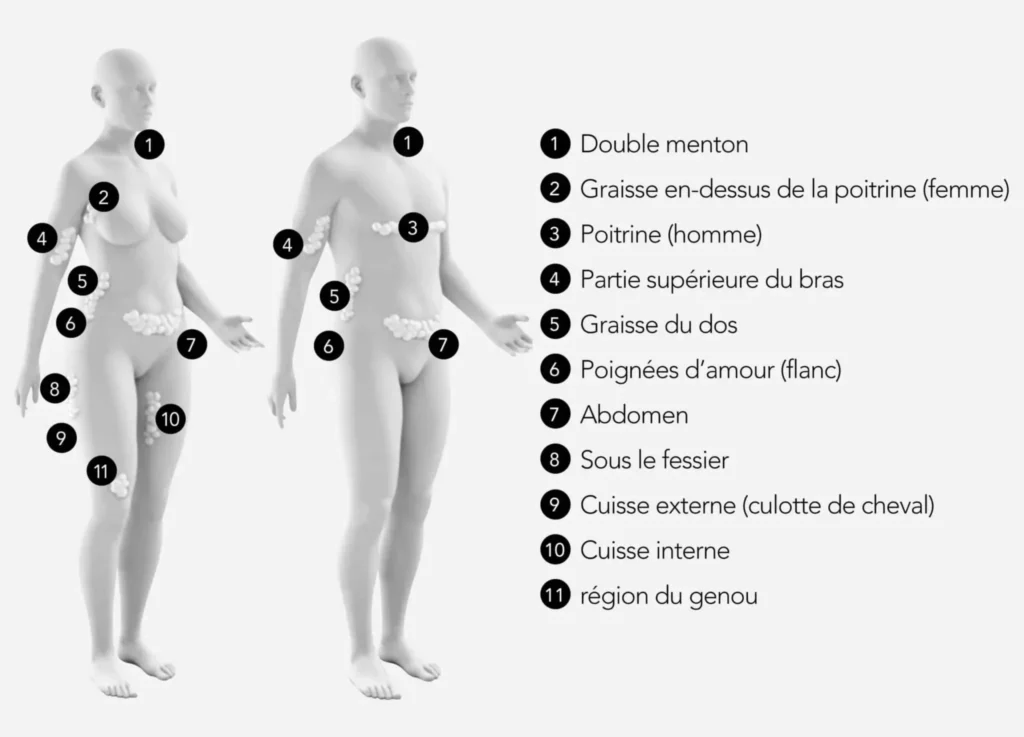 Dessin montrant Les parties du corps hommes et femmes pouvant etre traitees Dr Favre Lausane