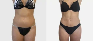 Ventre de femme de profil face avant apres Liposuccion Haute Definition 4 D | Dr Favre Lausanne