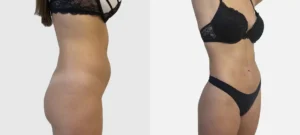 Photo du ventre d une femme avant apres Liposuccion Haute Definition 4 D | Dr Favre Lausanne