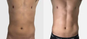 Photo du ventre d un homme de profil face avant apres Liposuccion Haute Definition 4 D | Dr Favre Lausanne