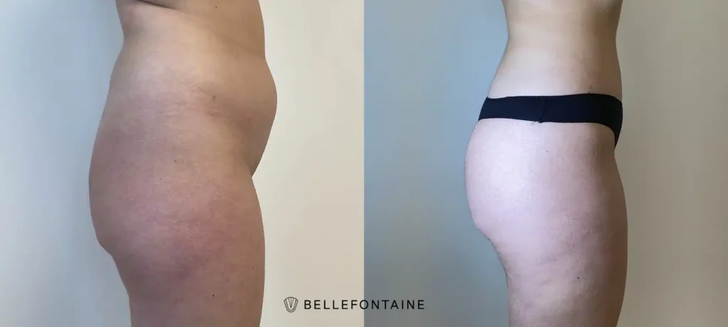 Ventre de femme de profil droit avant apres Liposuccion Haute Definition 4 D | Dr Favre Lausanne