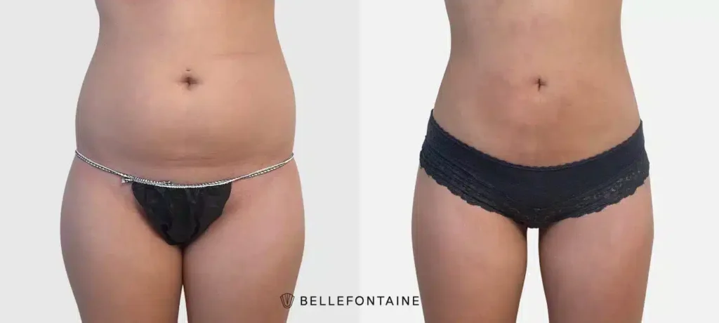 Ventre de femme de profil face avant apres Liposuccion Haute Definition 4 D | Dr Favre Lausanne