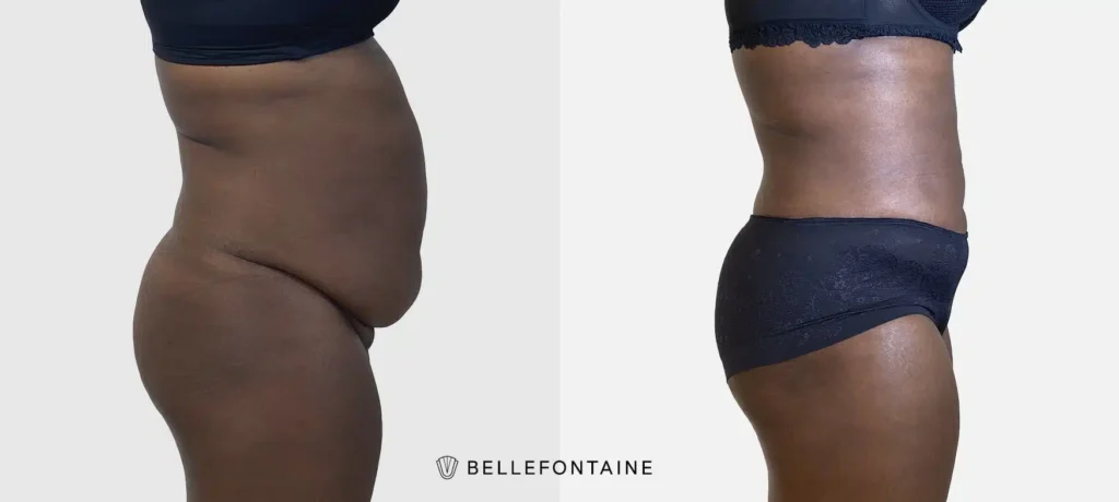 Ventre de femme noire de profil droit avant apres Liposuccion Haute Definition 4 D | Dr Favre Lausanne