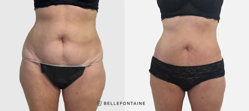 Photo du ventre d une femme de profil face avant apres Liposuccion Haute Definition 4 D | Dr Favre Lausanne