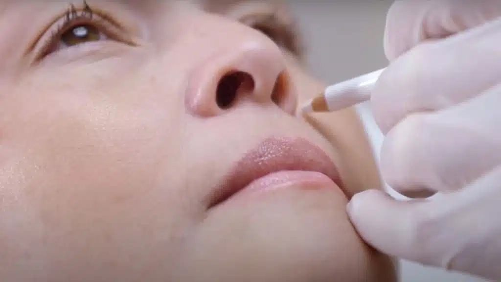 Thumbnails crayon sur visage de femme pour corriger une precedure bacle et botulinum Dr Favre Lausane