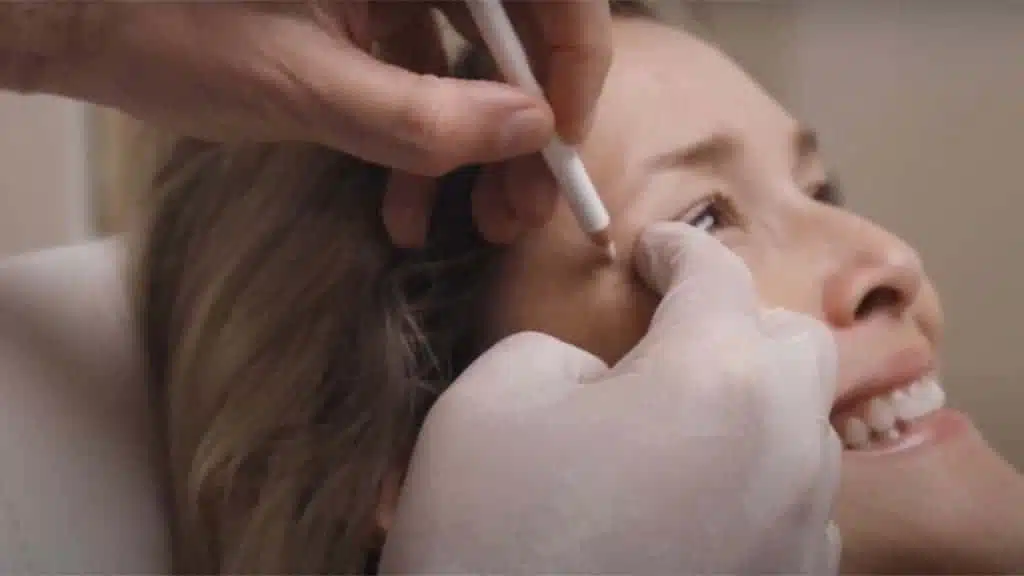 Thumbnails crayon sur visage de femme traitements par injection a l acide hyaluronique Dr Favre Lausane