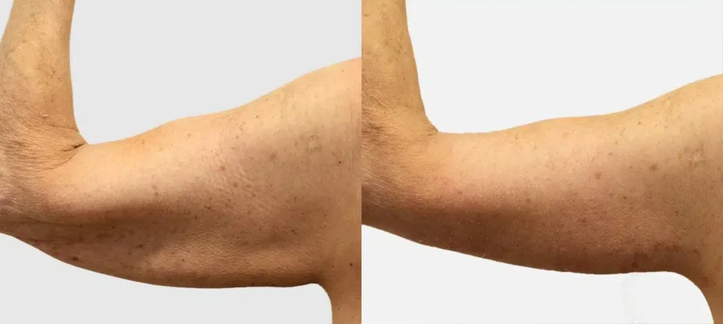 Photo comparative d un bras avant/apres d un homme qui a eu un Lifting des bras p| Dr Favre Lausanne