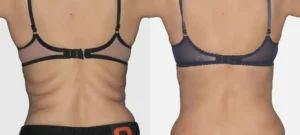 Dos d une femme avant/apres traitement par Renuvion | Dr Favre Lausanne