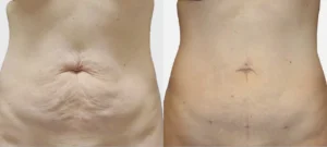 Ventre d une femme avant/apres traitement par Renuvion | Dr Favre Lausanne