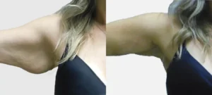 Bras d une femme agee avant/apres traitement par Renuvion | Dr Favre Lausanne