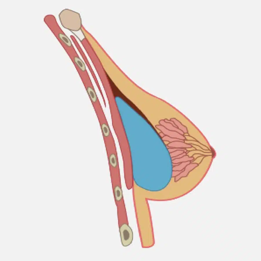 Illustration montrant le sein d'une femme apres une augmentation mammaire pres pectorale | Dr Favre Lausanne