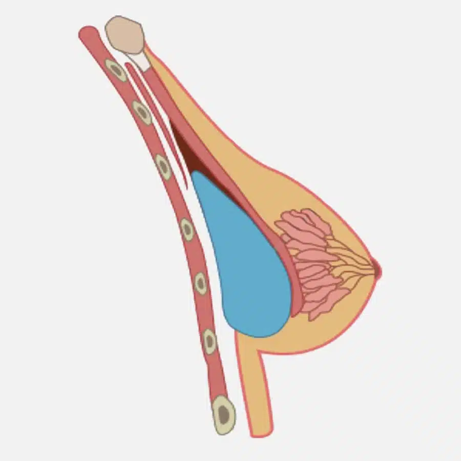 Illustration montrant le sein d'une femme apres une augmentation mammaire retro musculaire | Dr Favre Lausanne