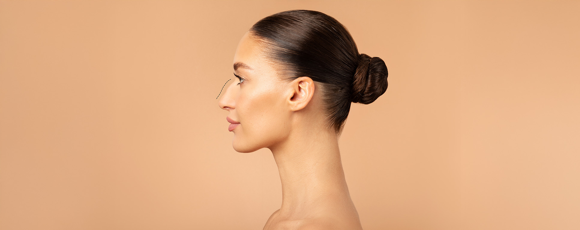 Acide hyaluronique pour le nez : rhinoplastie médicale à Lausanne