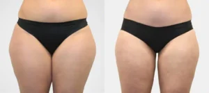 Ventre et bassin d une femme avant/apres liposuccion | Dr Favre Lausanne