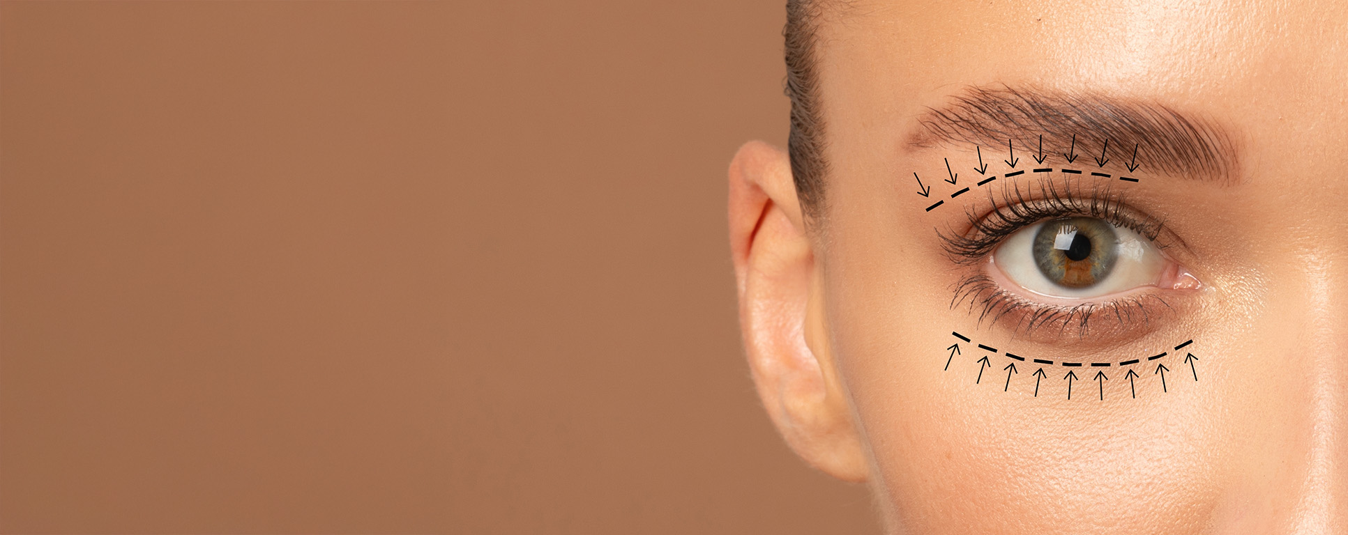 Blépharoplastie inférieure à Lausanne