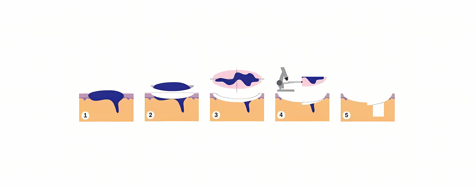 Chirurgie de mohs à Lausanne | Chirurgie micrographique de mohs | Chirurgie esthétique | Dr Yann Favre