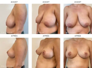 Poitrine de femme de profil face avant/apres augmentation mammaire | Dr Favre Lausanne