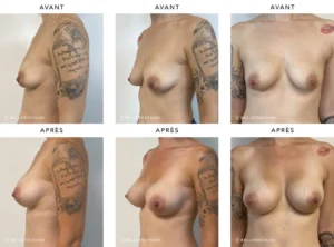 Poitrine de femme de profil face avant/apres augmentation mammaire | Dr Favre Lausanne