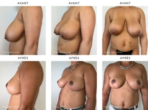 Poitrine de femme de profil face avant/apres reduction mammaire | Dr Favre Lausanne