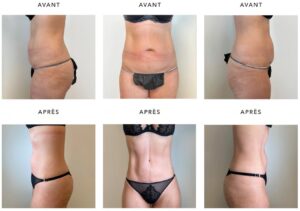 Ventre de femme avant/apres Lifting du ventre | Dr Favre Lausanne