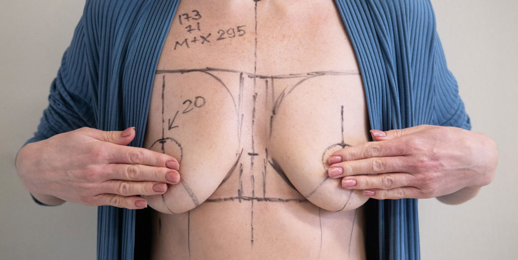 Consignes et préparation avant une augmentation mammaire