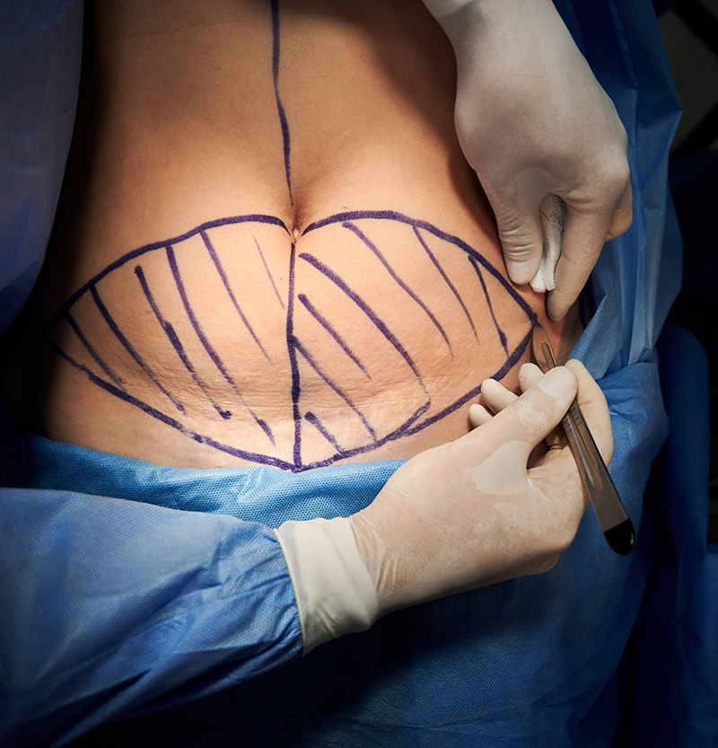 Ablauf und Besonderheiten einer Abdominoplastik