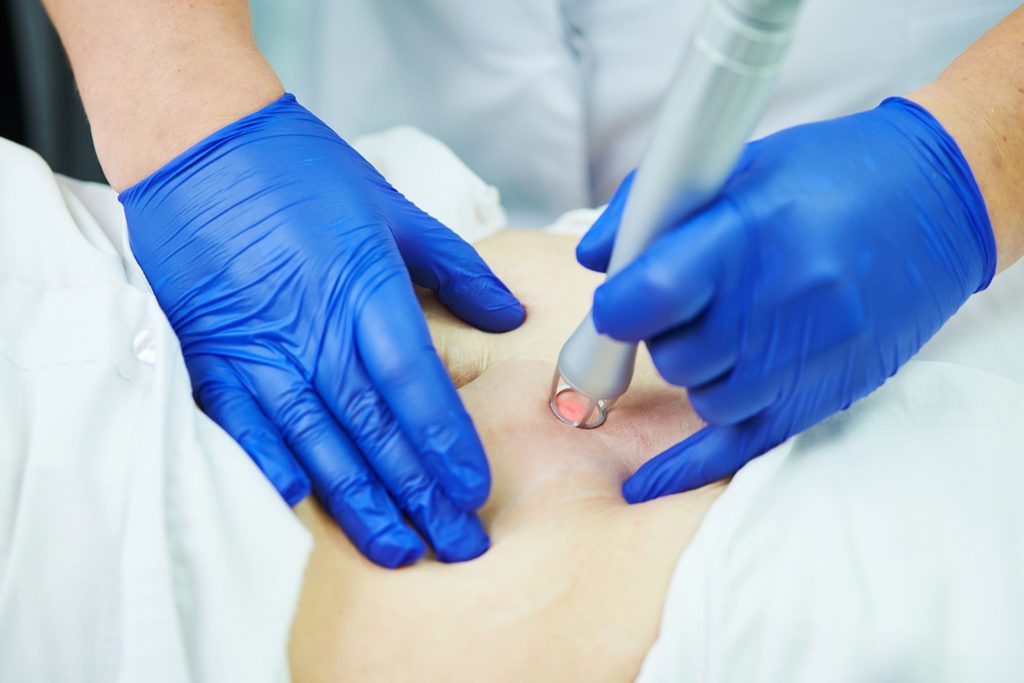 Traitements pour atténuer une cicatrice après abdominoplastie