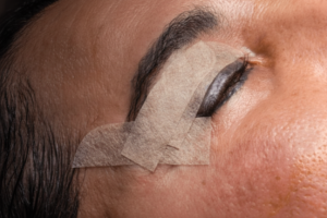 Convalescence après une blépharoplastie