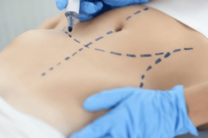 Risks and complications associated with liposuction