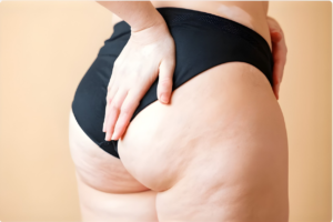 Cellulite persistante après un BBL