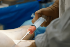 Réduction des risques associés à l’injection de graisse au cours d’un BBL