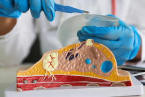 Risk of a breast implant rupturing